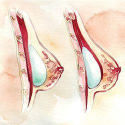 Medical diagram comparing breast implant placement above and below the pectoralis muscle
