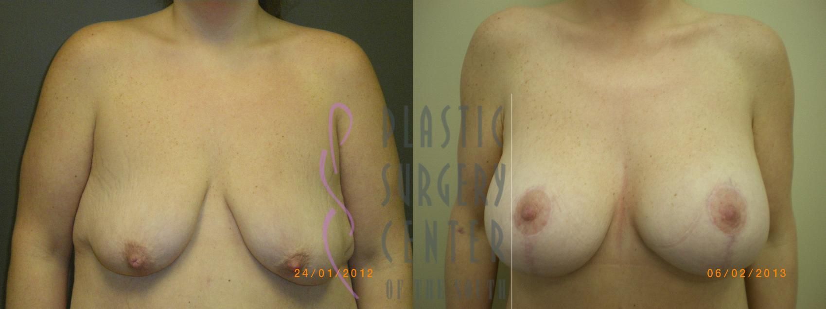 Comparison of breasts before and after surgery.