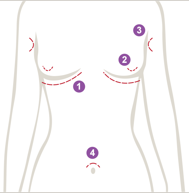 Diagram of the female torso with numbered surgical incision markings.