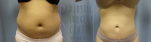 Before and after liposuction result