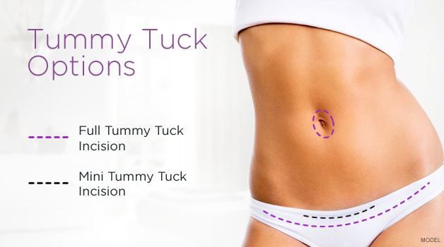 Diagram of tummy tuck incision options: full and mini, with woman's abdomen and dashed lines indicating cuts.