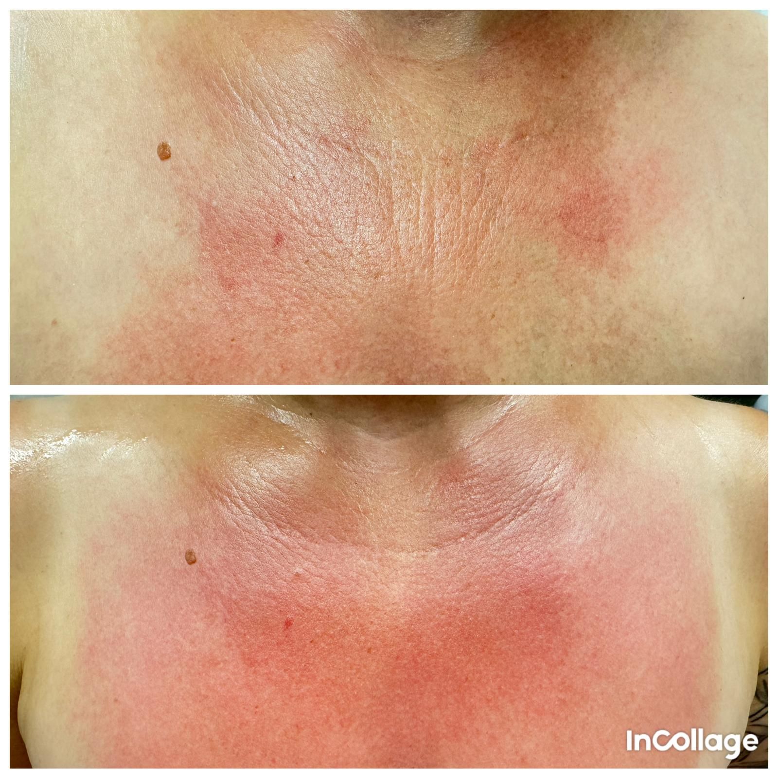 Ein Vorher-Nachher-Foto vom Hals und der Brust einer Frau.