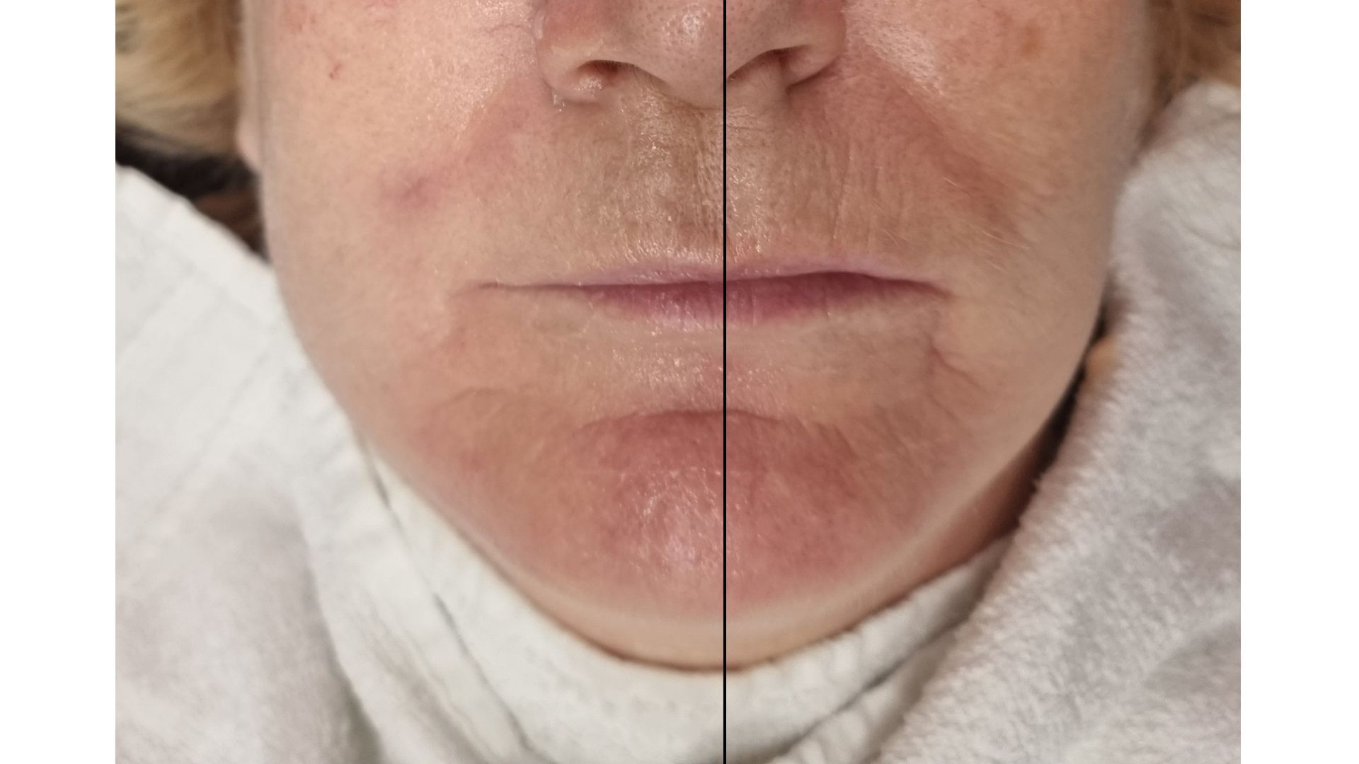 Ein Vorher-Nachher-Foto vom Gesicht einer Frau.