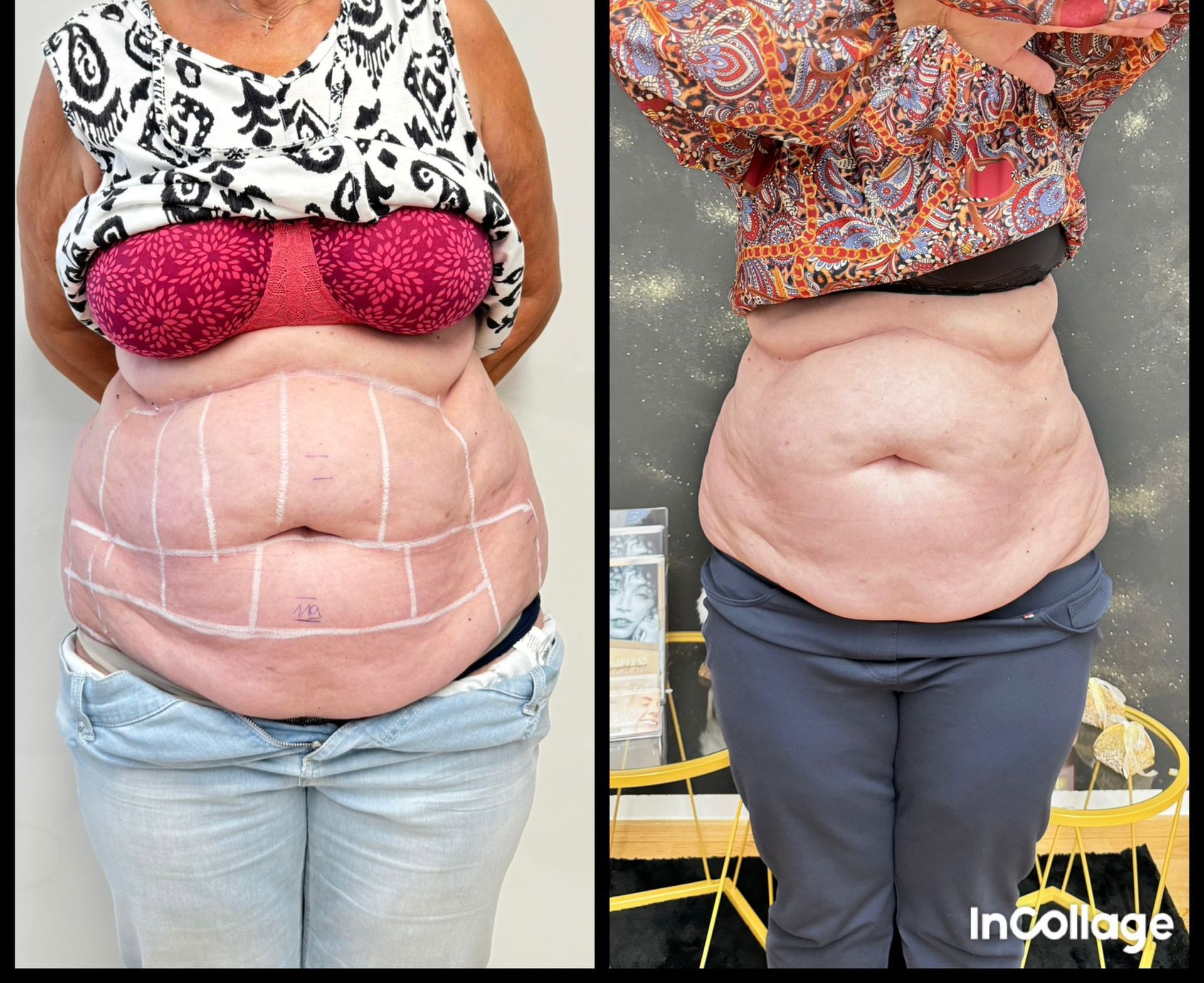 Ein Vorher-Nachher-Foto vom Bauch einer Frau