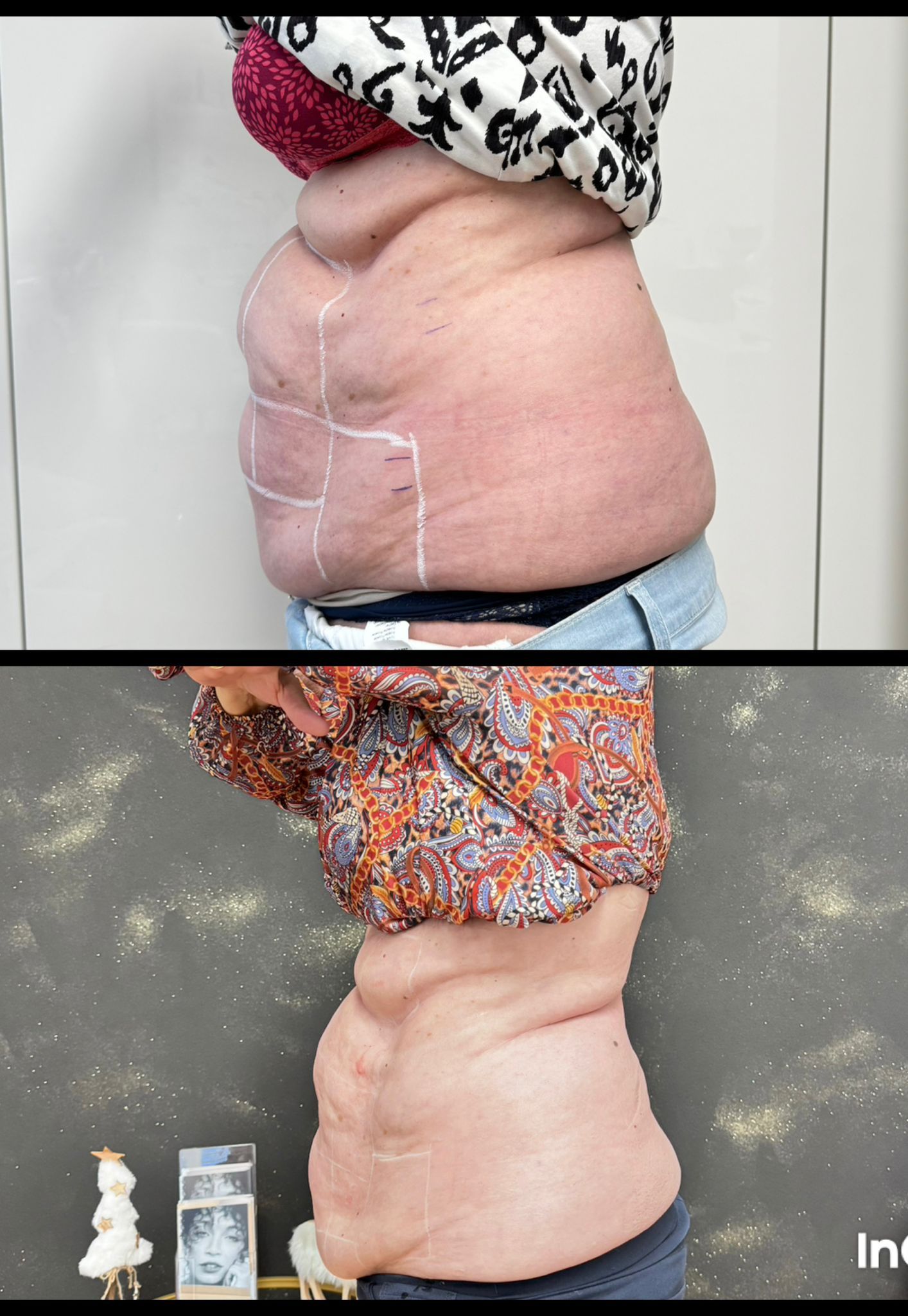 Ein Vorher-Nachher-Foto vom Bauch einer Frau