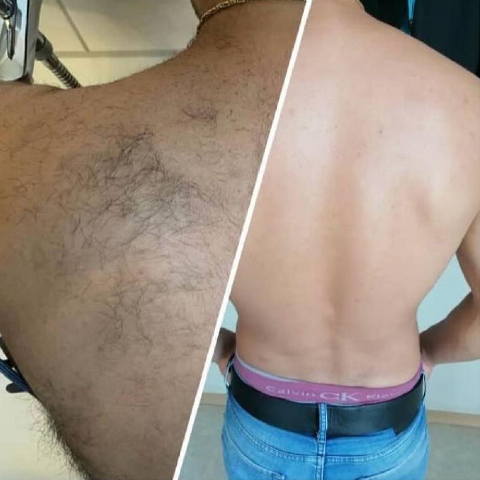 Ein Vorher-Nachher-Bild vom Rücken eines Mannes