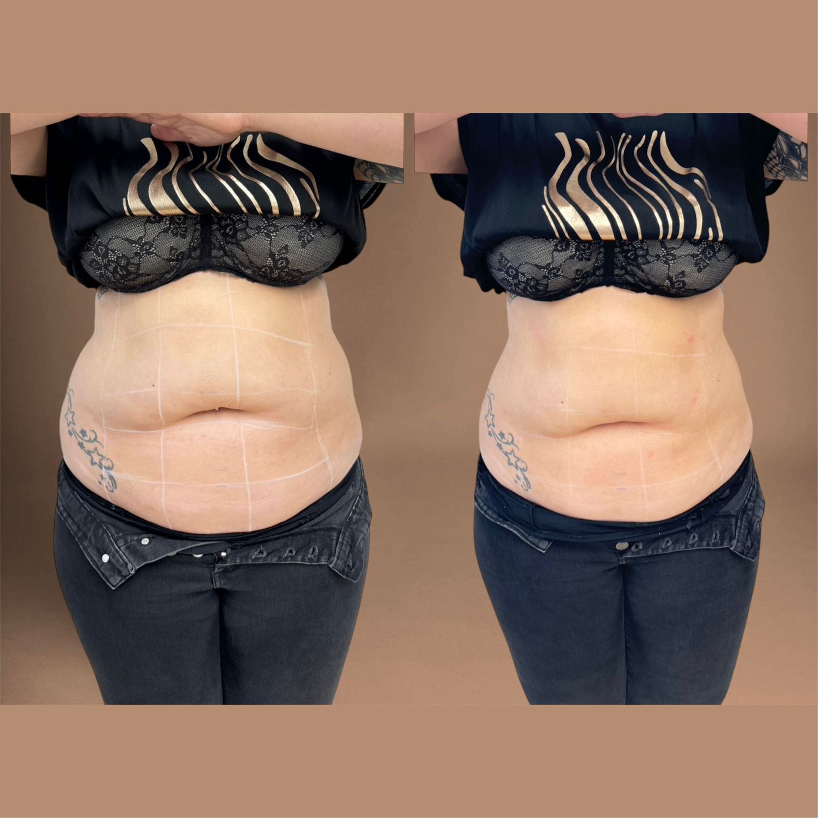Ein Vorher-Nachher-Bild vom Bauch einer Frau.