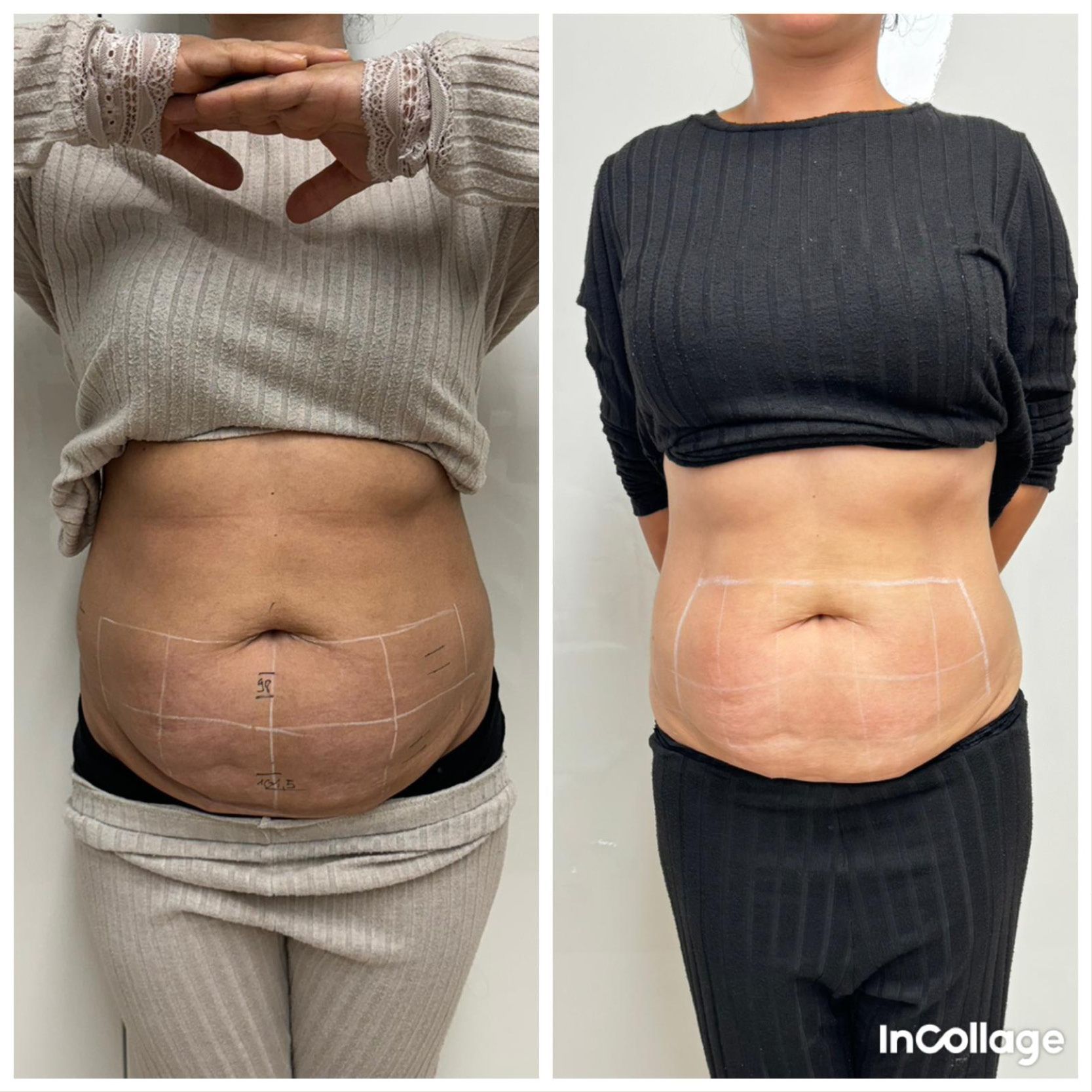 Ein Vorher-Nachher-Foto vom Bauch einer Frau.