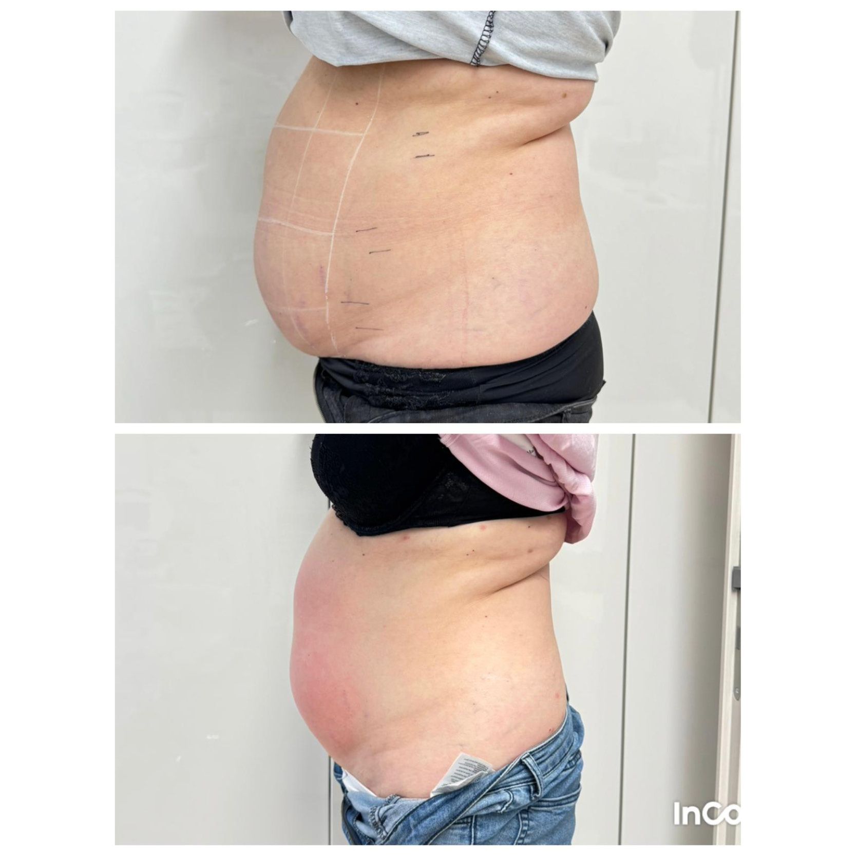 Ein Vorher-Nachher-Bild vom Bauch einer Frau.