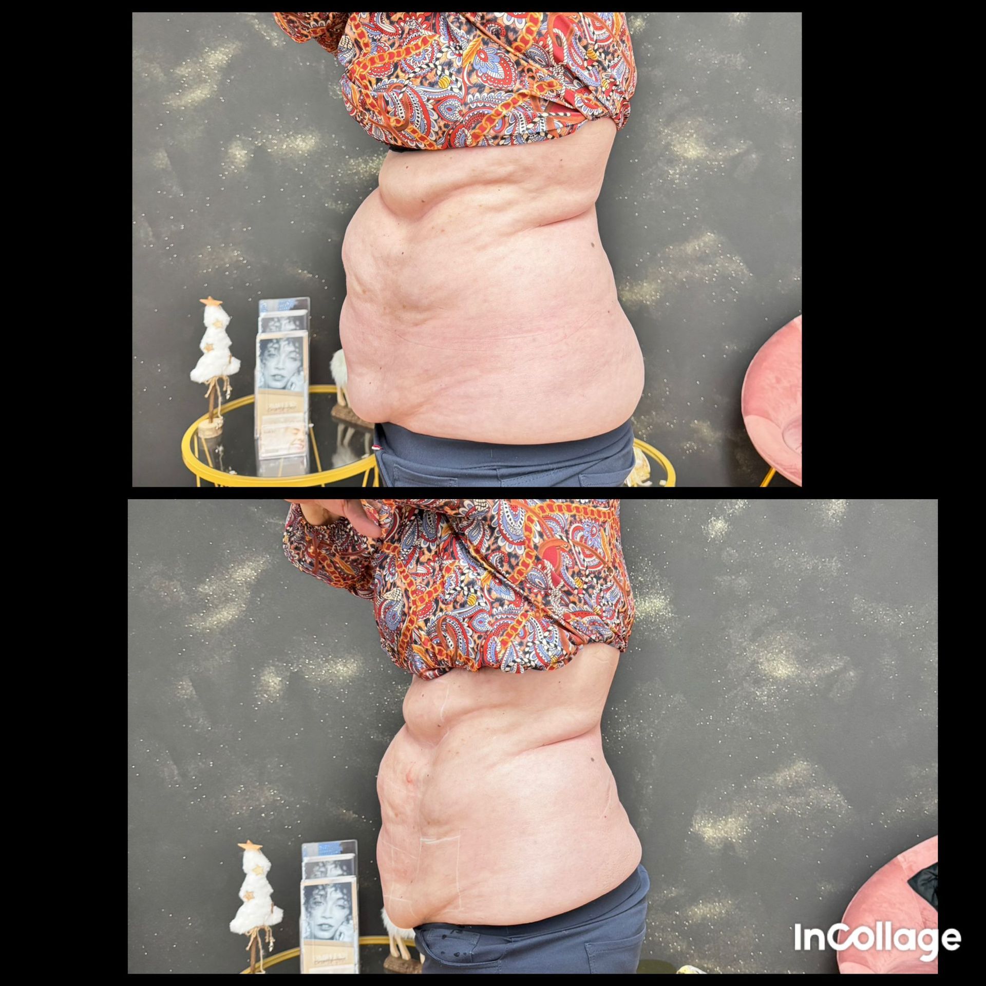 Der Bauch einer Frau wird vor und nach der Gewichtsabnahme gezeigt.
