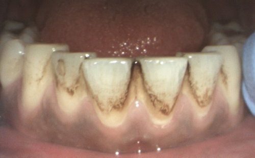 Close-up of human teeth with significant brown staining near the gumline.