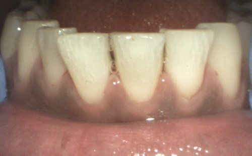 Close-up of teeth in a mouth, showing the gums and some saliva. The teeth appear clean and white.