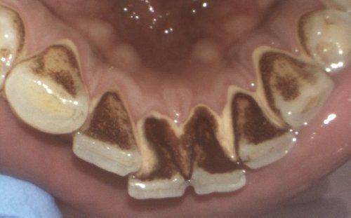 Brown staining on the lower front teeth, likely from diet or bacteria.