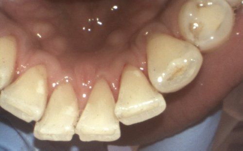 Close-up view of lower teeth, showing chipped edges and slight discoloration.
