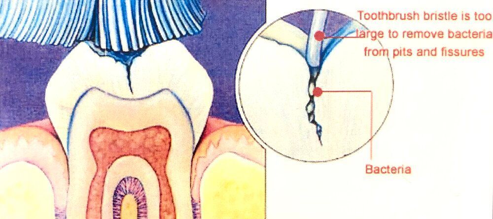 Cross-section of a tooth with toothbrush bristles above. Zoom shows a toothbrush bristle is too large to remove bacteria from pits.