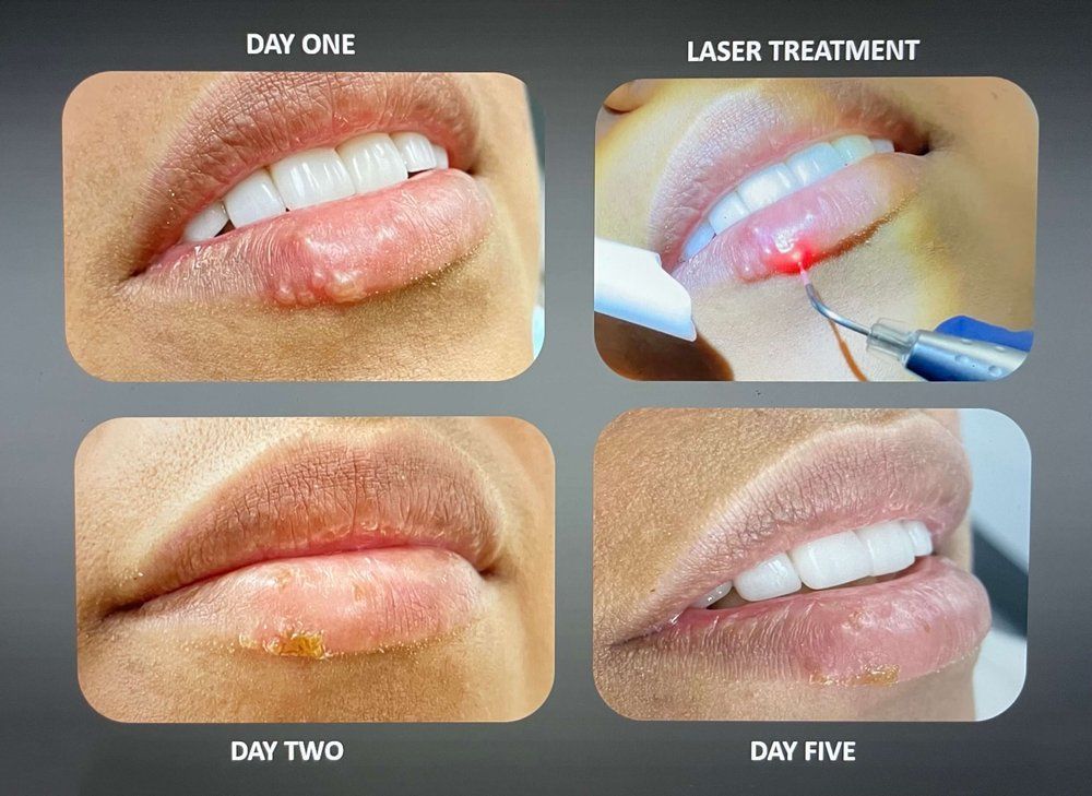 Four photos showing laser treatment for a lip sore: Before, during laser use, day two, and day five with healing.