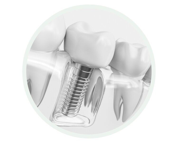 Diagram of a dental implant: a screw-like base embedded in the jawbone, supporting a crown.
