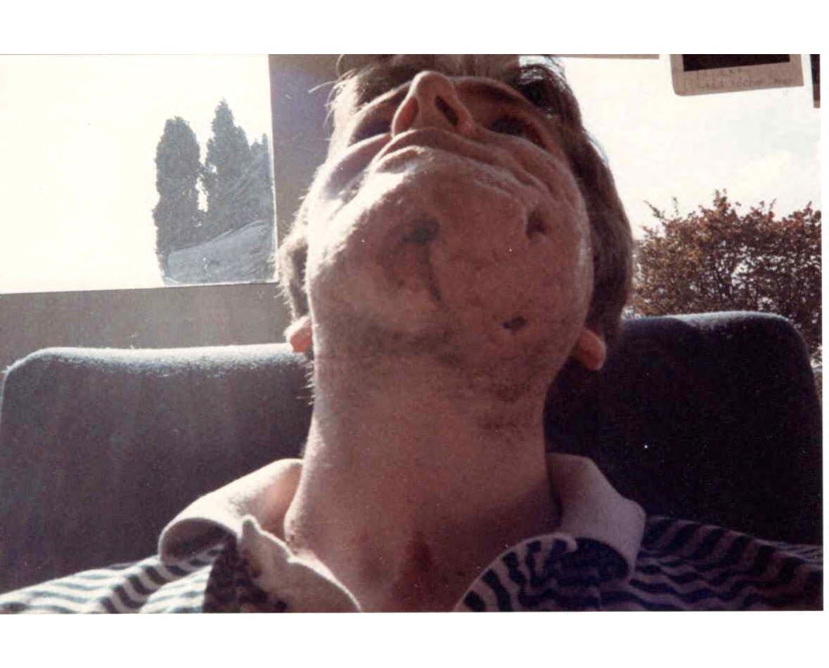 A man with a scarred chin and jaw.