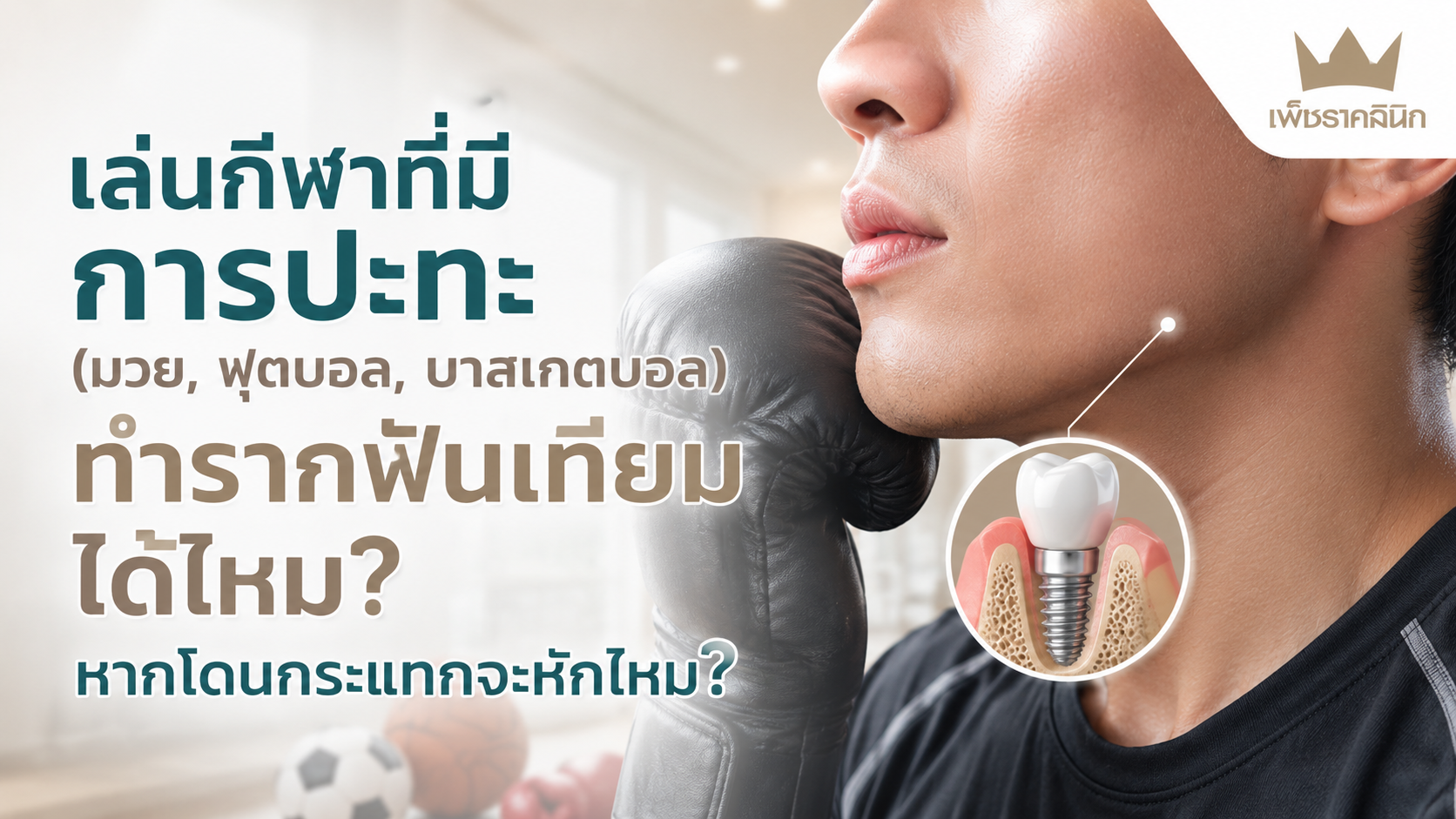 dental-implant-contact-sports-safety-guide
