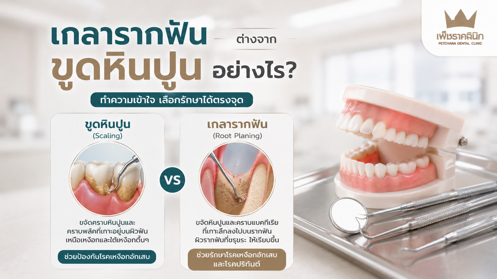 เกลารากฟันต่างจากขูดหินปูนอย่างไร? คู่มือเจาะลึก 5 ข้อแตกต่างและวิธีรักษาโรคปริทันต์