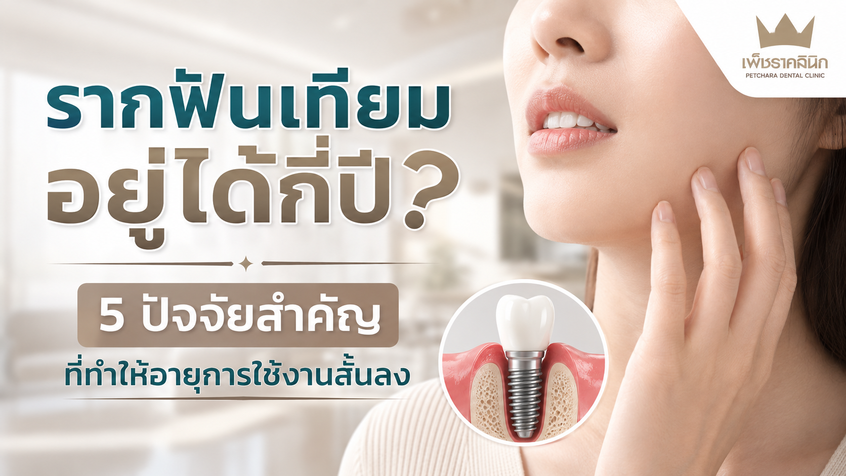 รากฟันเทียมอยู่ได้กี่ปี? 5 ปัจจัยสำคัญที่ทำให้อายุการใช้งานสั้นลง