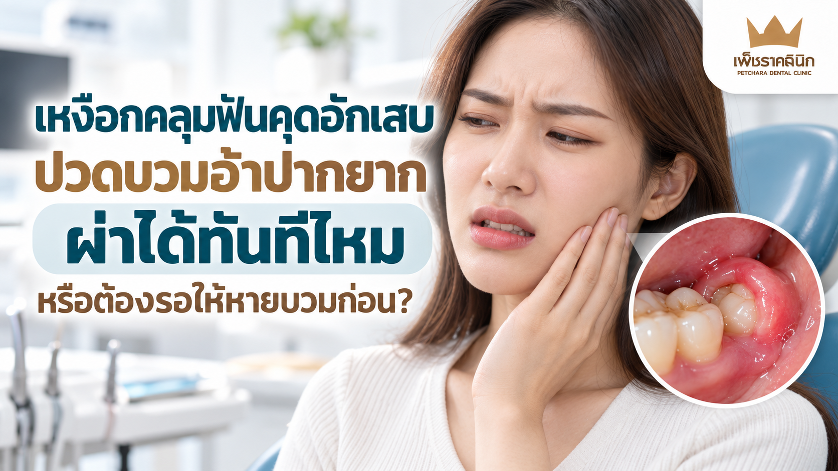 pericoronitis-wisdom-tooth-infection-treatment-guide