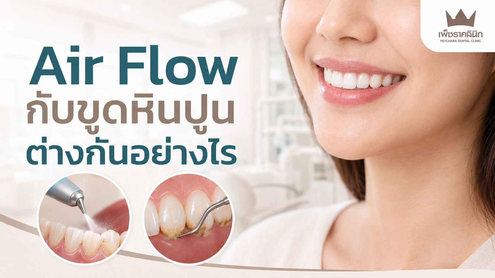 Air Flow กับขูดหินปูนต่างกันอย่างไร? คู่มือเจาะลึก 5 ข้อแตกต่างและวิธีทำความสะอาดฟันขั้นสุด