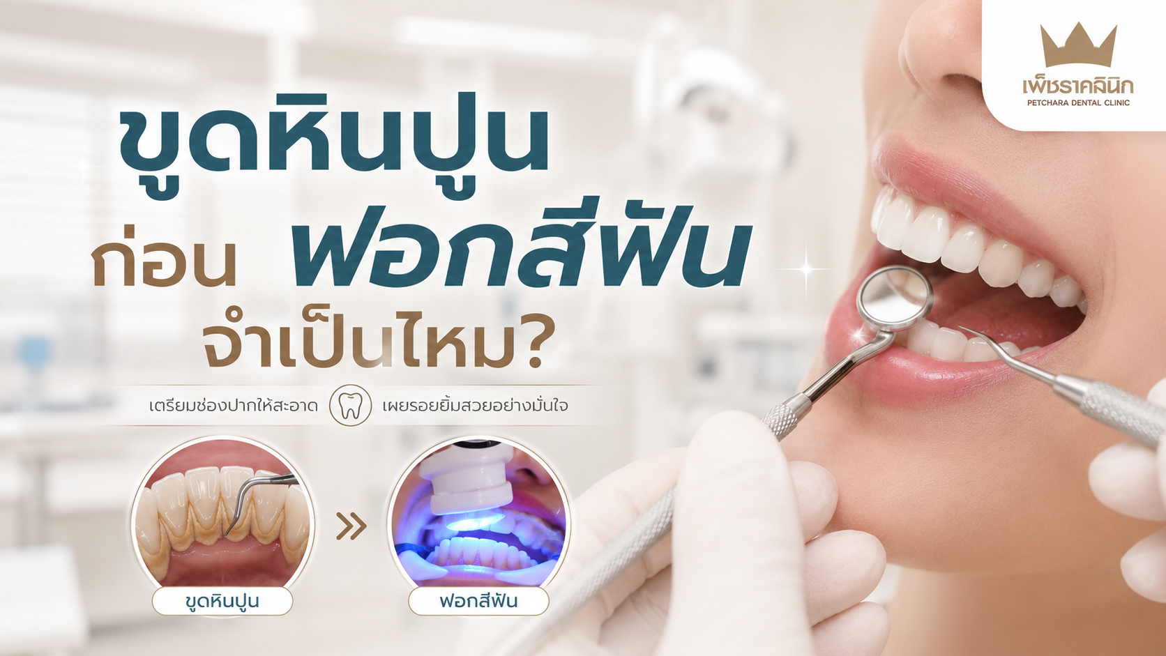 is-scaling-before-teeth-whitening-necessary-guide
