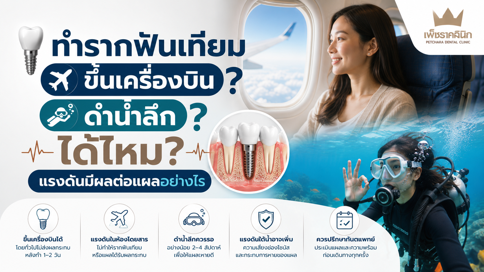 dental-implant-flying-scuba-diving-guide