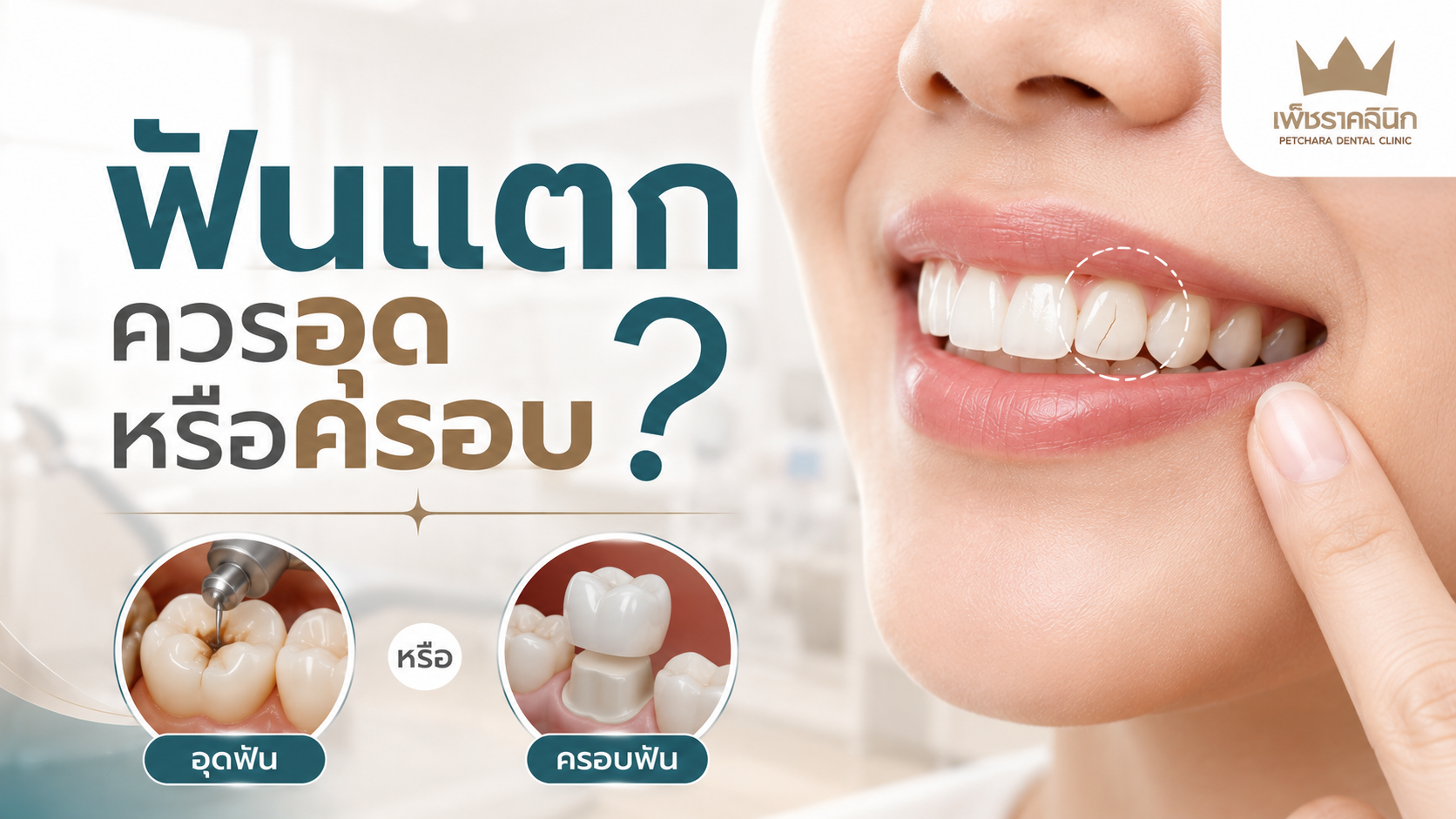 chipped-broken-tooth-filling-vs-crown-decision-guide
