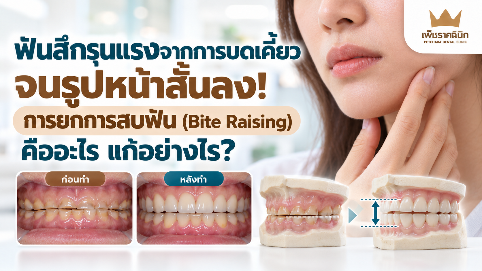 bite-raising-severe-tooth-wear-full-mouth-rehab-guide