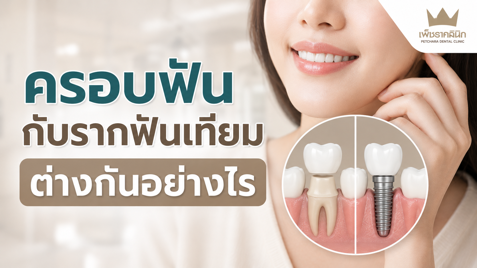 ครอบฟันกับรากฟันเทียมต่างกันอย่างไร? เลือกแบบไหนตอบโจทย์สุขภาพช่องปากที่สุด