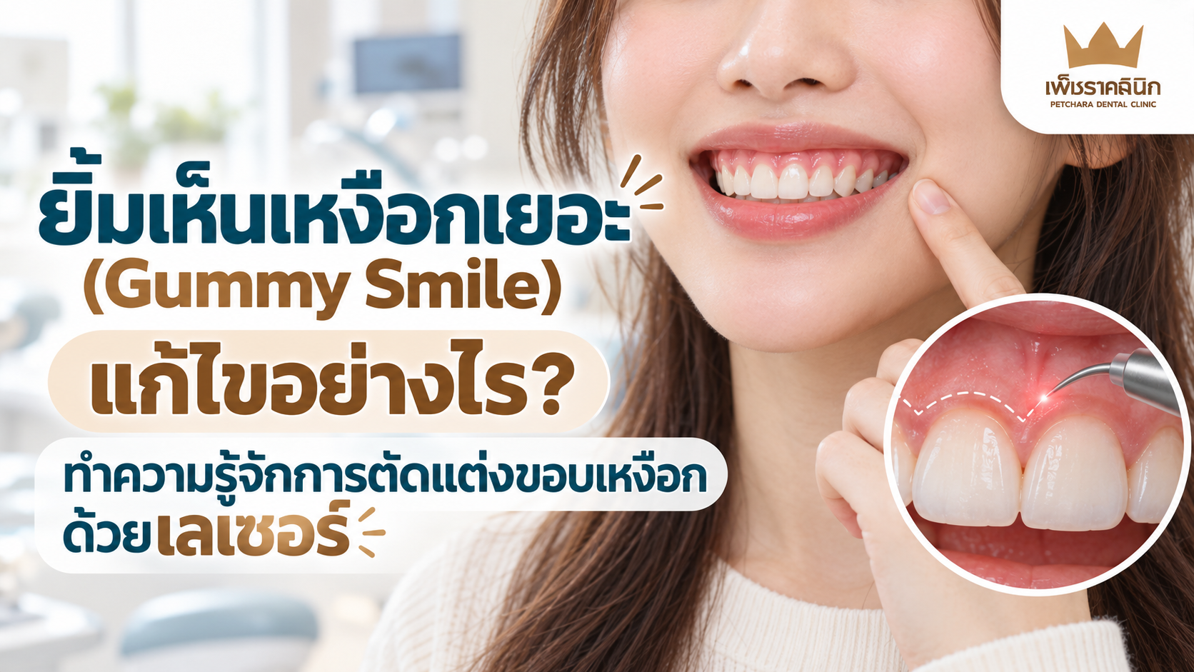 gummy-smile-laser-gum-contouring-treatment-guide