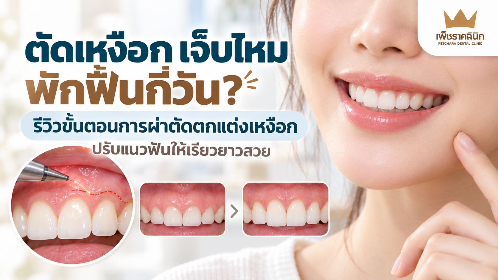 gingivectomy-pain-recovery-timeline-treatment-guide