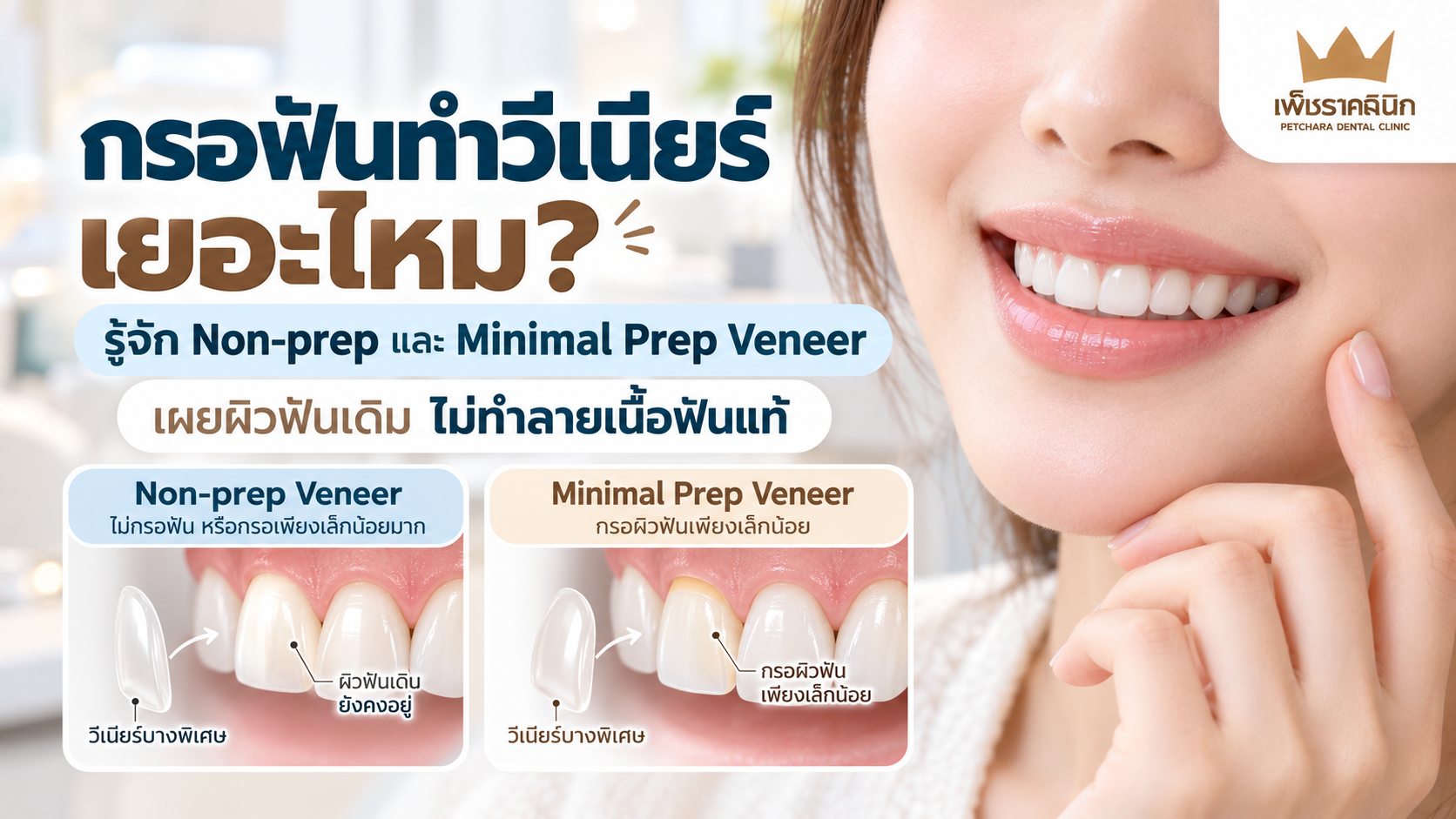 prep-vs-non-prep-veneer-guide