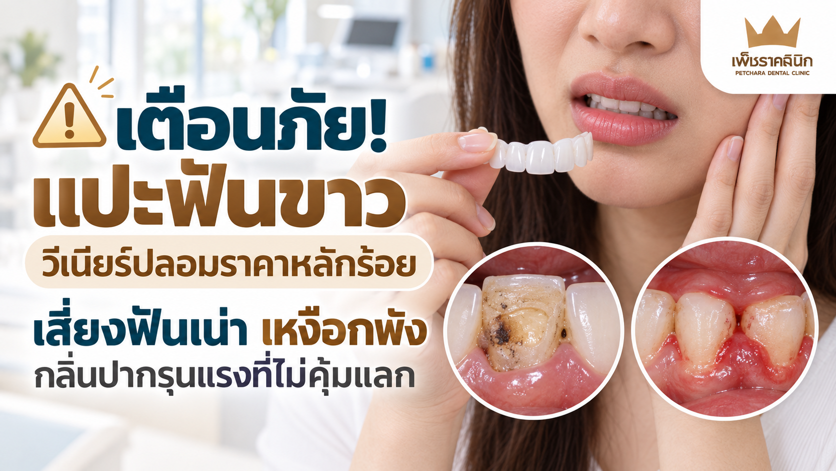 dangers-of-fake-veneers-treatment-guide