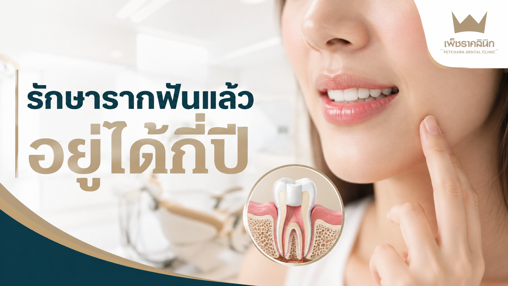 root-canal-treatment-lifespan-durability-care-guide