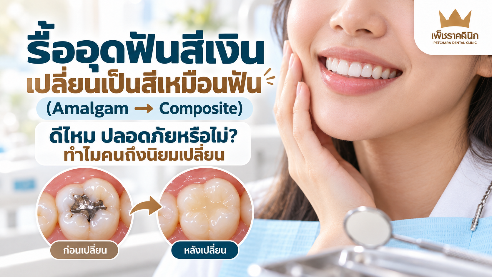 amalgam-to-composite-filling-replacement-guide