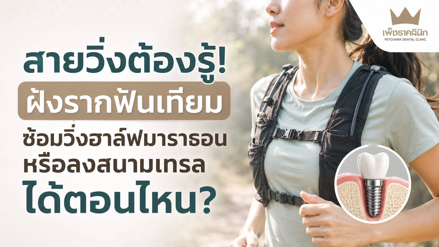 dental-implant-running-half-marathon-trail-guide