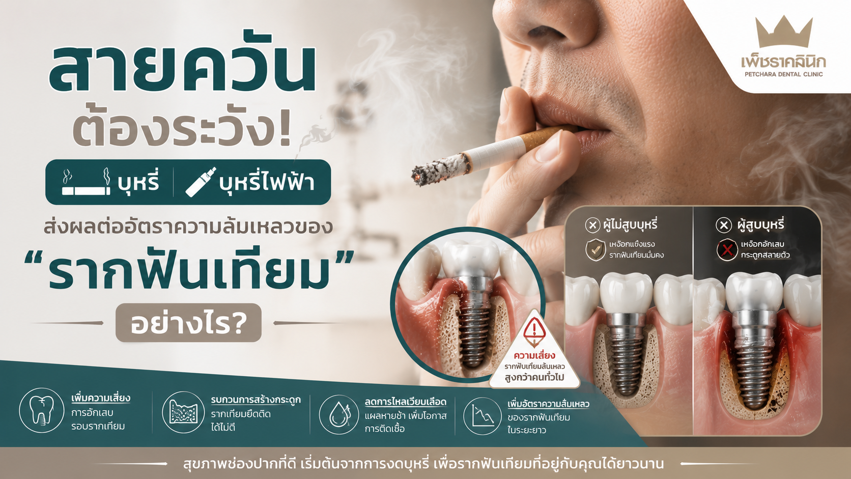 Slug: effect-of-smoking-on-dental-implant-failure