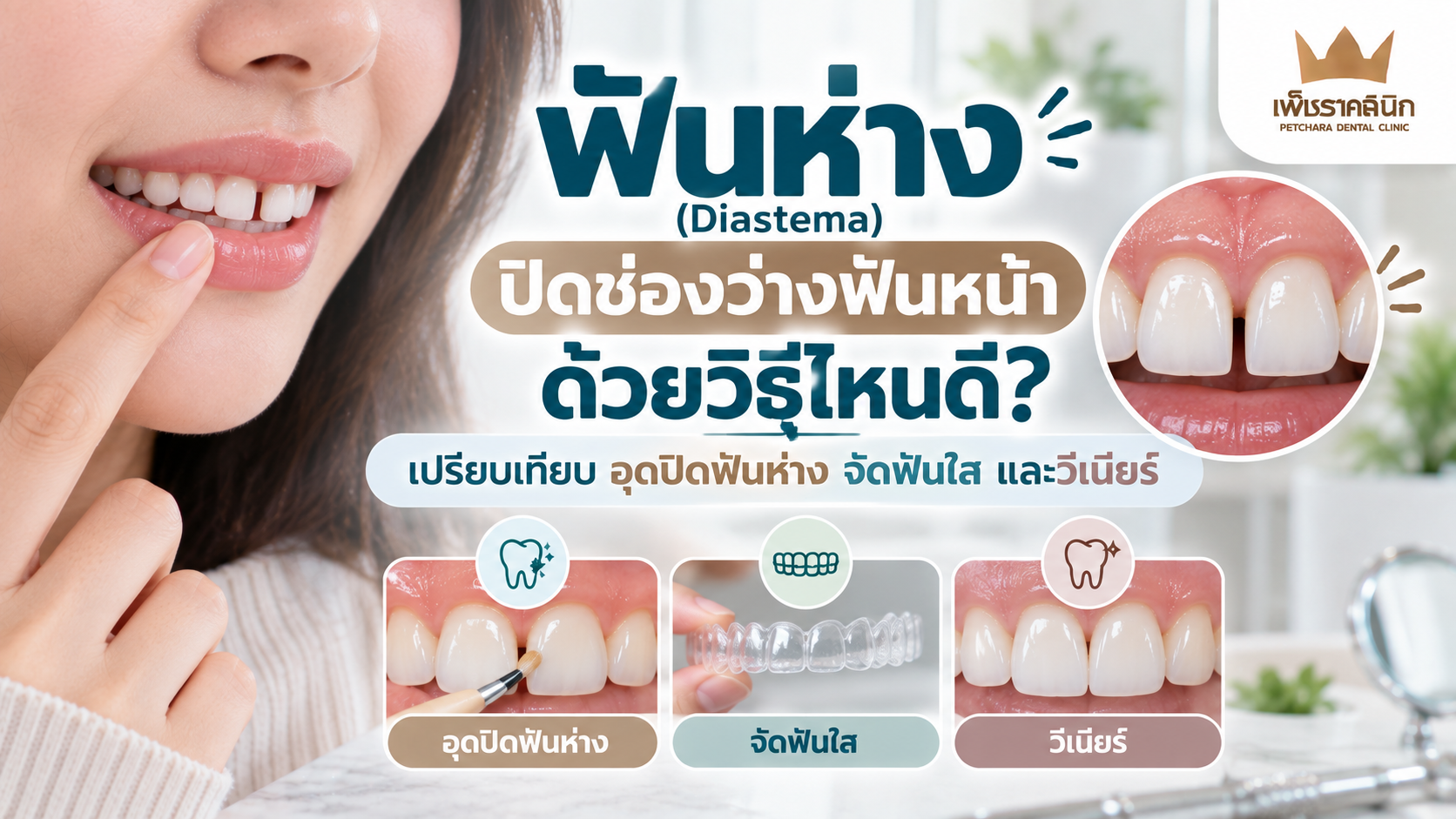 diastema-gap-teeth-treatment-comparison