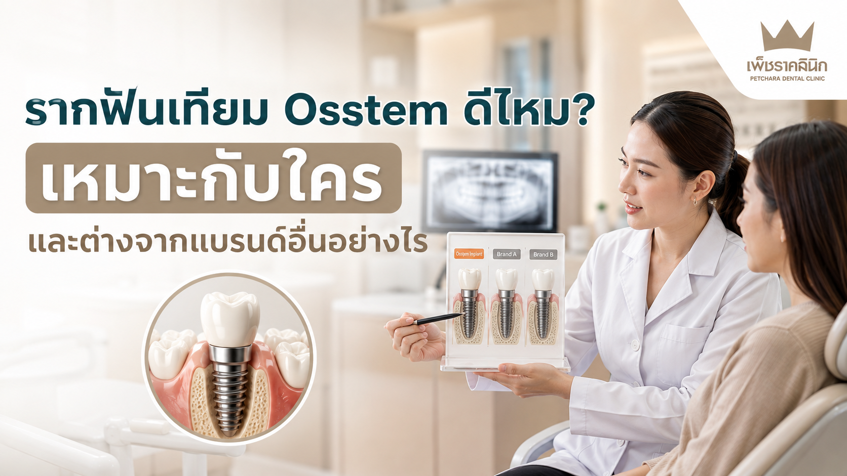 รากฟันเทียม Osstem ดีไหม? เหมาะกับใคร และต่างจากแบรนด์อื่นอย่างไร