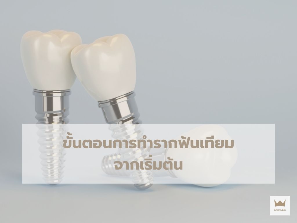 ขั้นตอนการทำรากฟันเทียมจากเริ่มต้น