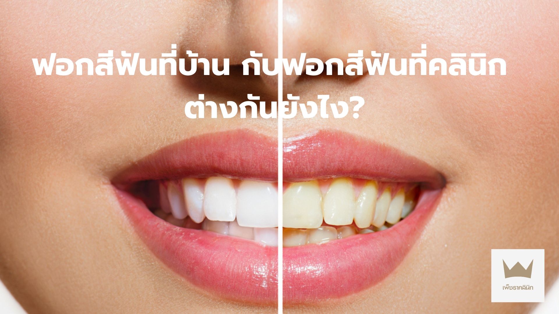 ฟอกสีฟันที่บ้าน กับฟอกสีฟันที่คลินิก ต่างกันยังไง?