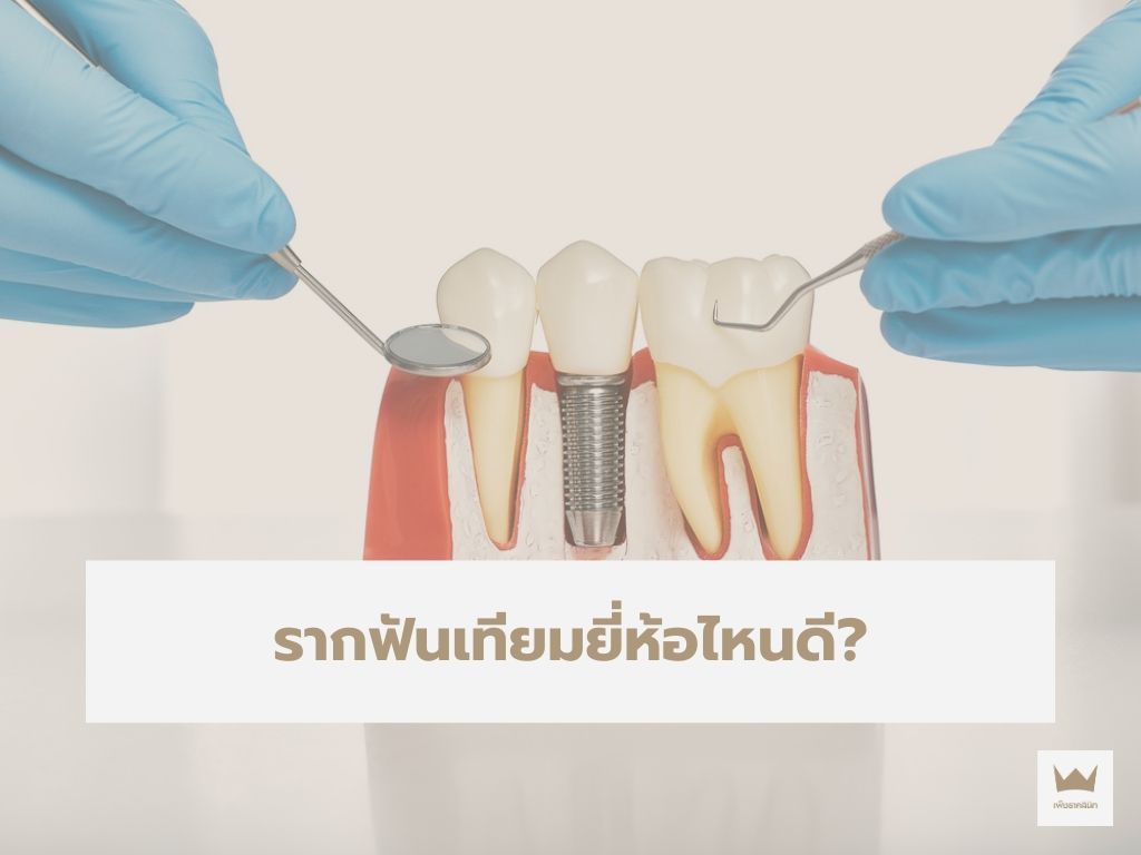 รากฟันเทียมยี่ห้อไหนดี? เปรียบเทียบ 3 แบรนด์ยอดนิยม
