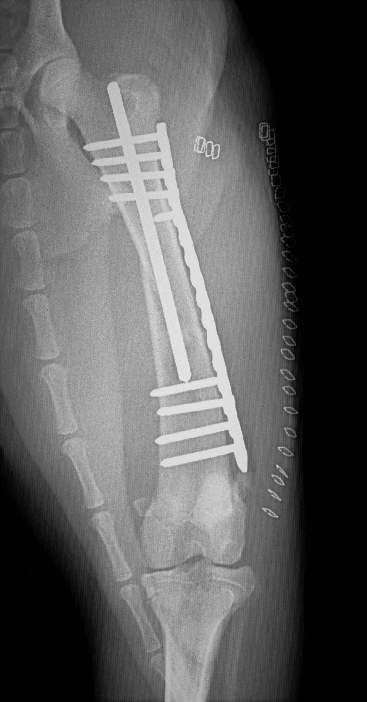 AAH femur fracture repair radiograph