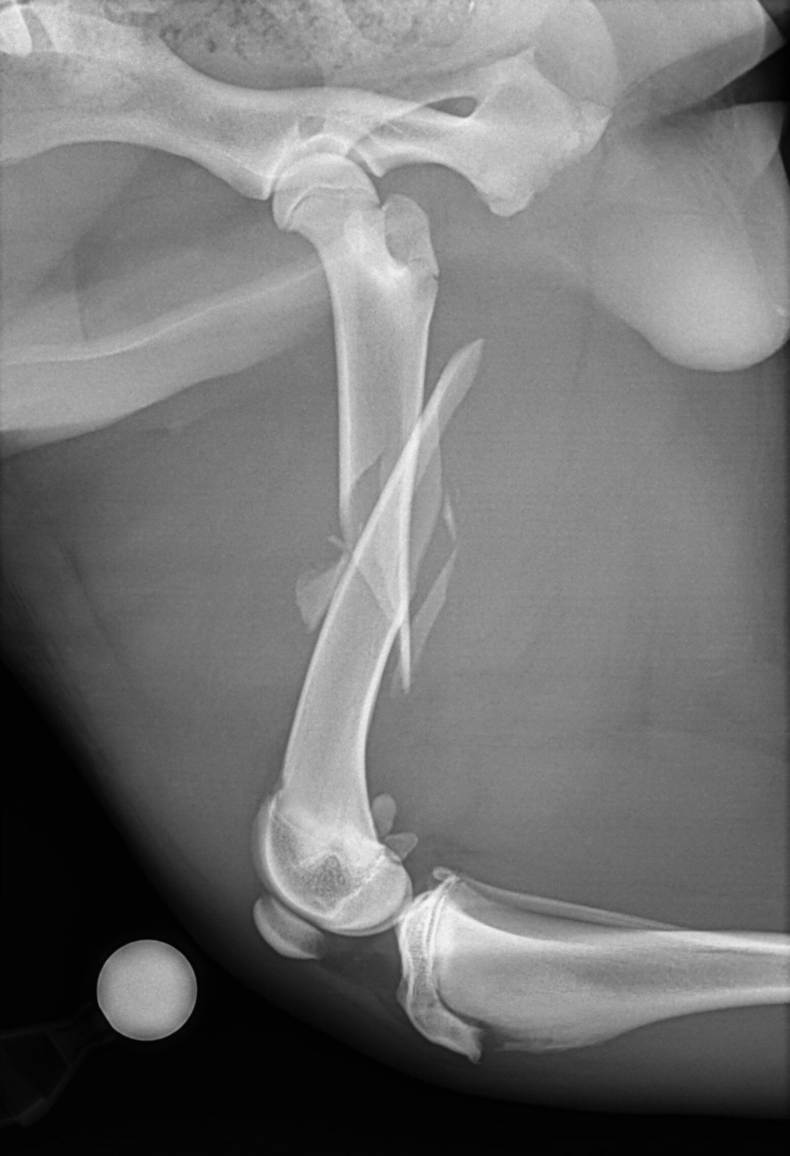 AAH femur fracture radiograph