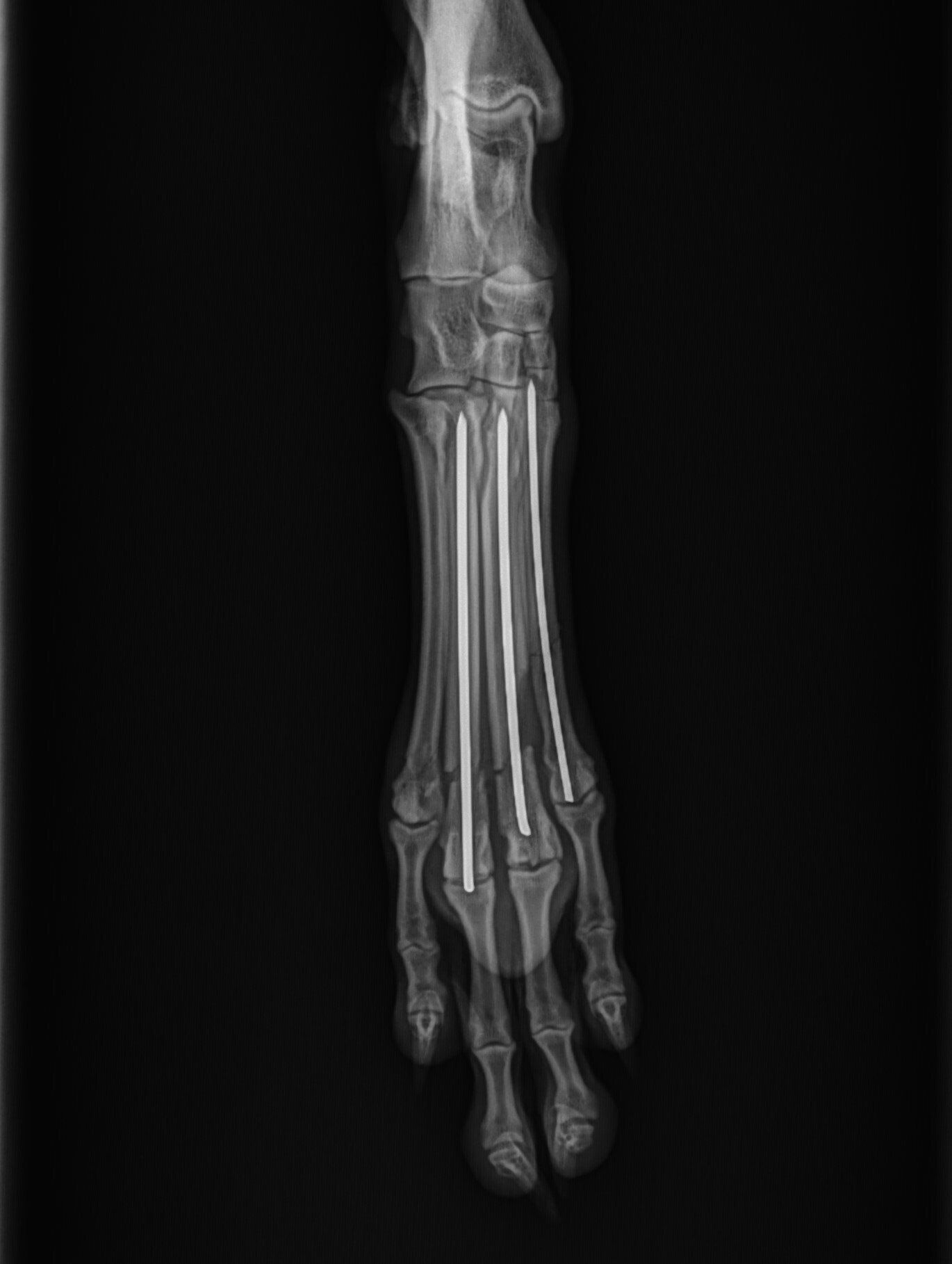 AAH foot fracture repair radiograph