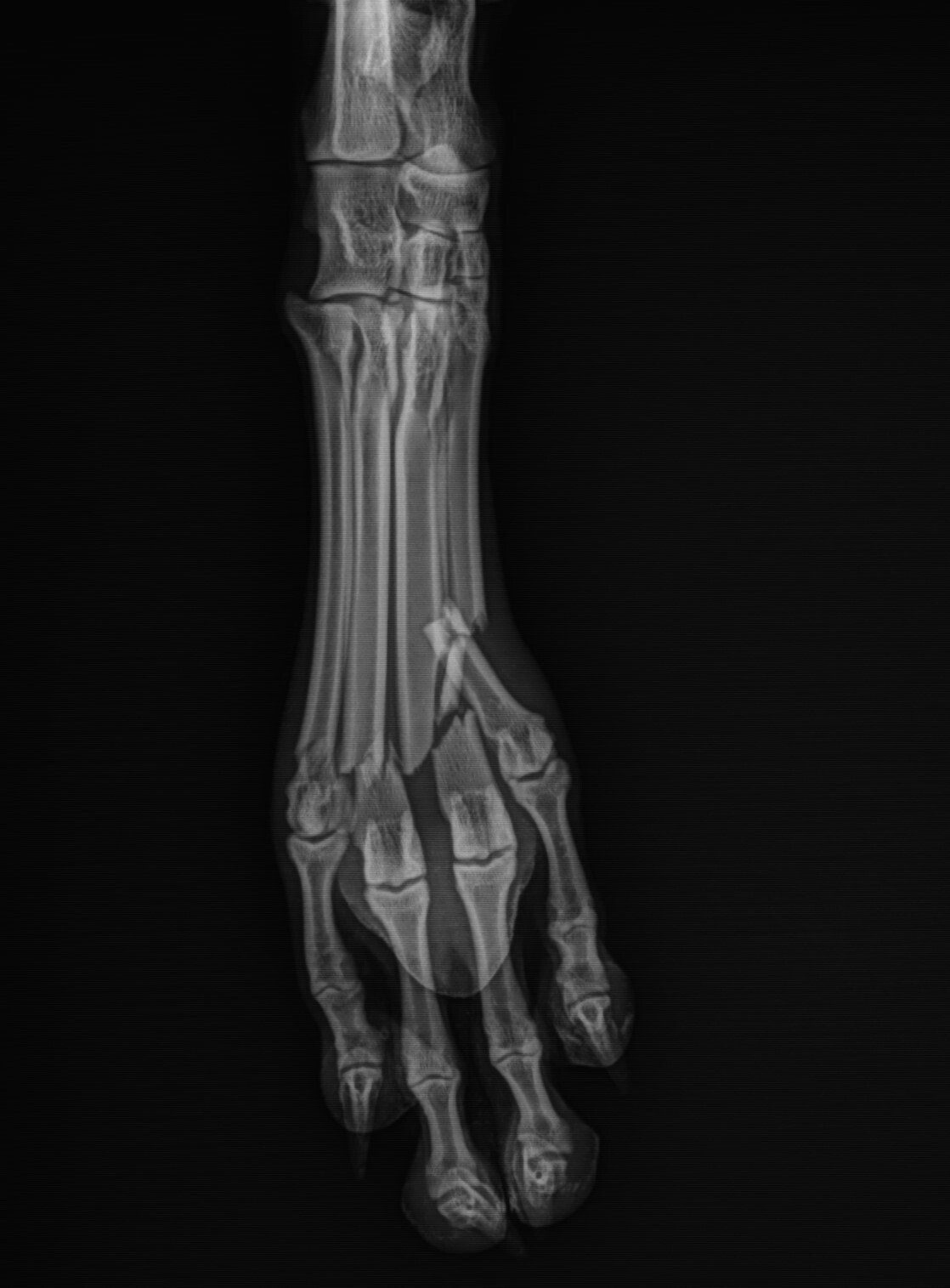 AAH foot fracture radiograph