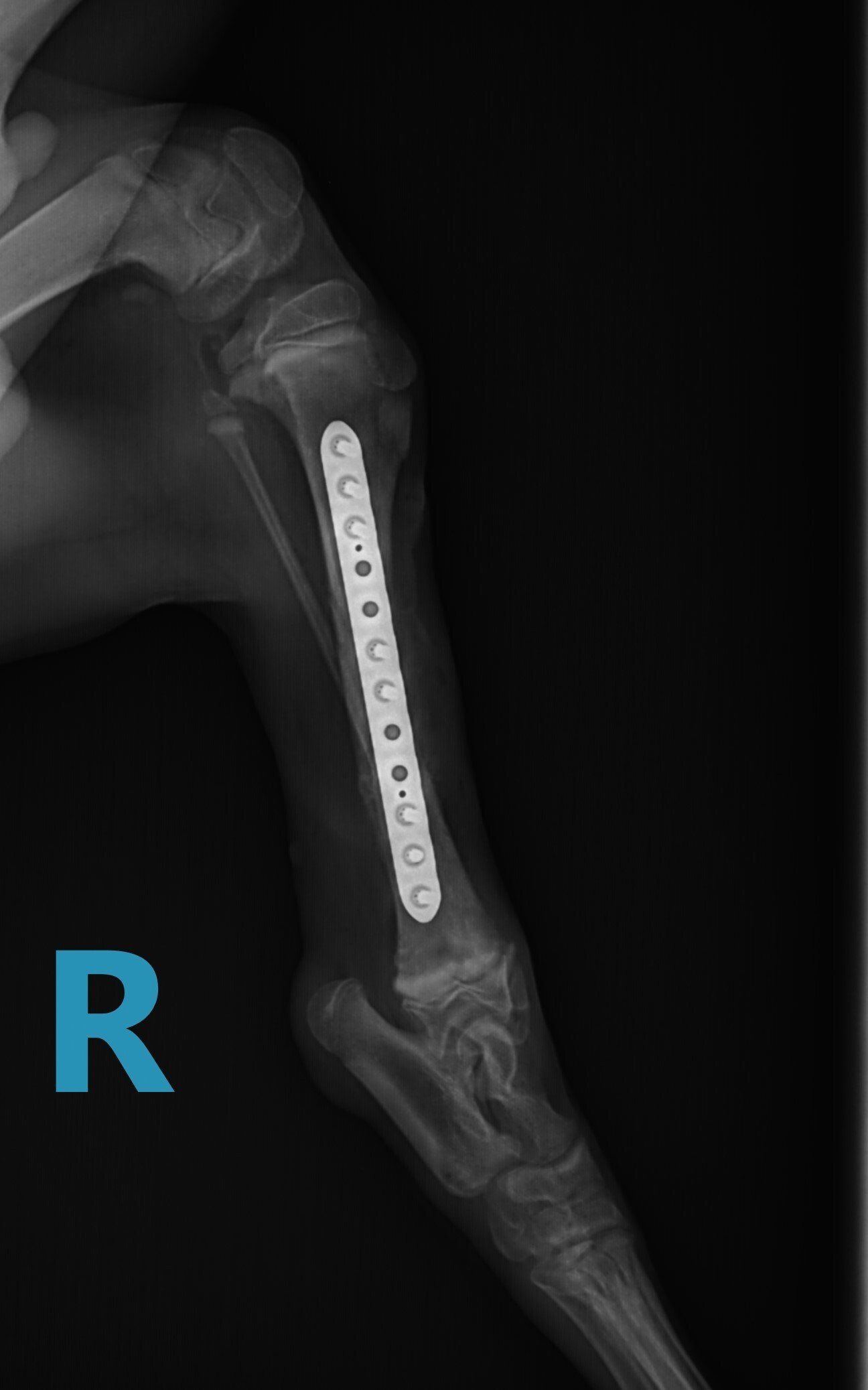 AAH tibia fracture repair radiograph